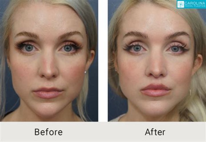 Botox, Facelift, Nose Job, Lip Augmentation & More!